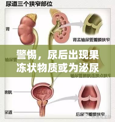 警惕，尿后果凍狀物或暗示泌尿系統(tǒng)健康危機