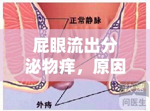 肛門(mén)分泌物異常，原因、癥狀及處理方法