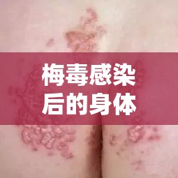 梅毒感染警示，識(shí)別身體異常液體排放