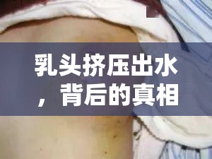 乳頭擠壓出水，背后的真相與應(yīng)對(duì)策略