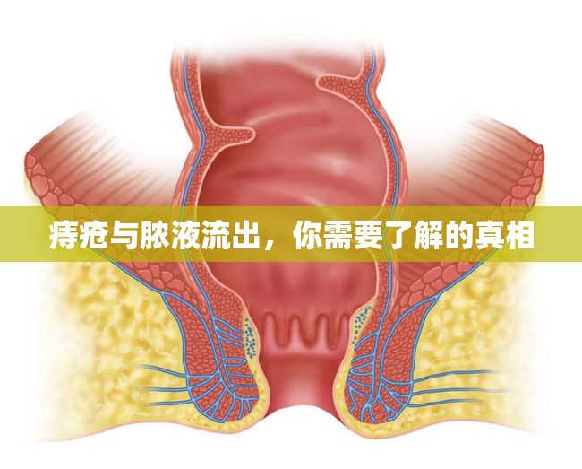 痔瘡與膿液流出，你需要了解的真相