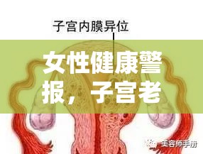 女性健康警報，子宮老感覺有血絲流出的應(yīng)對策略