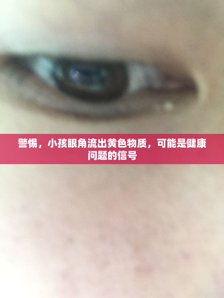 警惕，小孩眼角流出黃色物質，可能是健康問題的信號