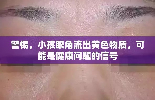 警惕，小孩眼角流出黃色物質(zhì)，可能是健康問題的信號