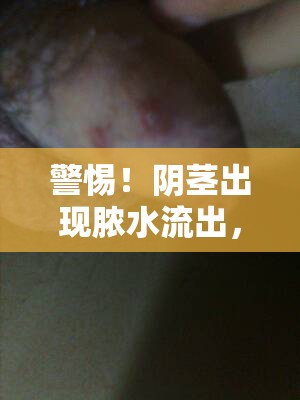 警惕！陰莖出現(xiàn)膿水流出，原因、癥狀與應對措施