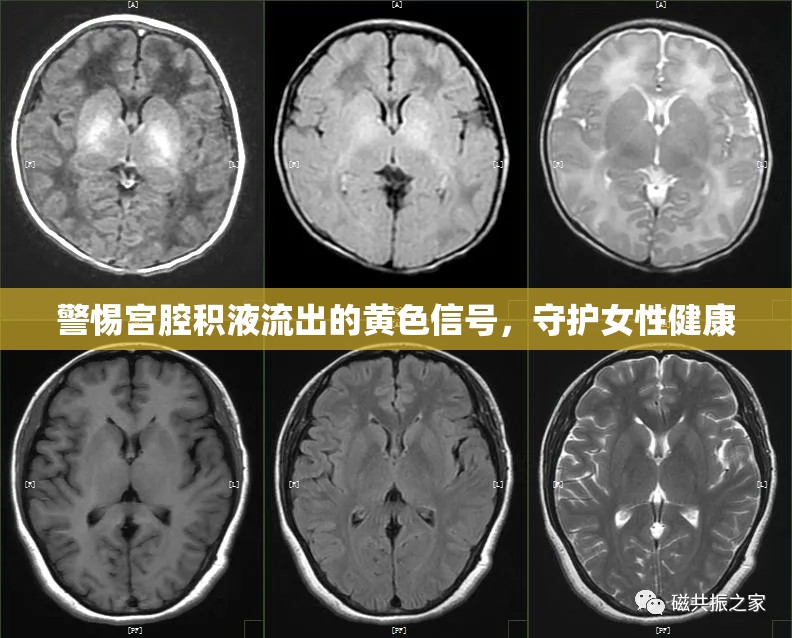 警惕宮腔積液流出的黃色信號，守護女性健康