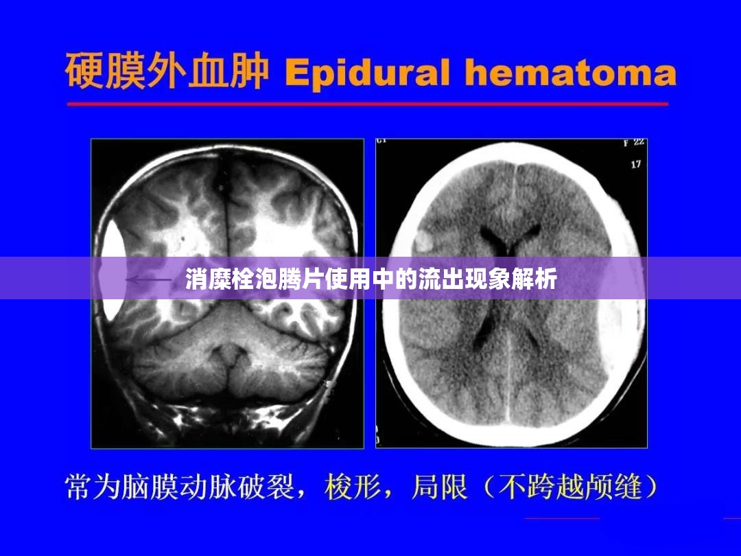 消糜栓泡騰片使用中的流出現(xiàn)象解析