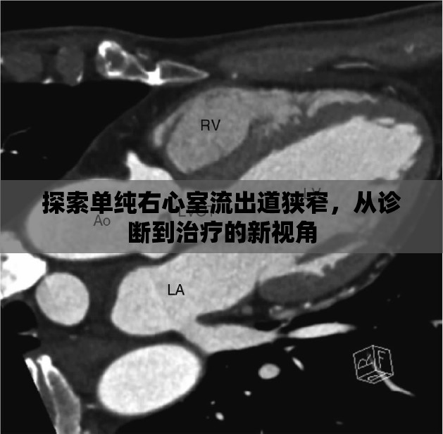 探索單純右心室流出道狹窄，從診斷到治療的新視角