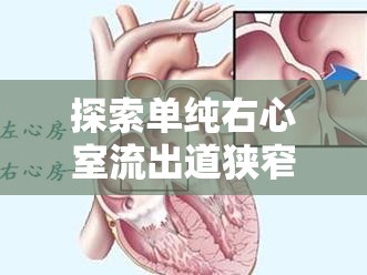 探索單純右心室流出道狹窄，從診斷到治療的新視角