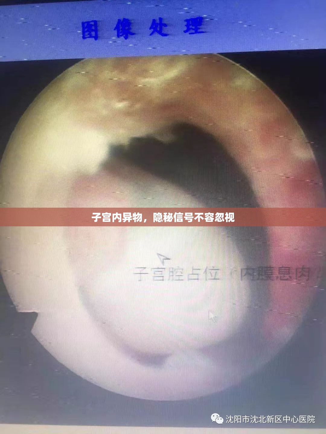 子宮內(nèi)異物，隱秘信號不容忽視