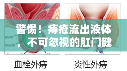 警惕！痔瘡流出液體，不可忽視的肛門健康警報(bào)