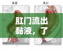 肛門流出黏液，了解癥狀、原因與應對策略