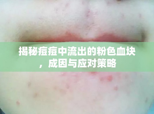 揭秘痘痘中流出的粉色血塊，成因與應(yīng)對策略