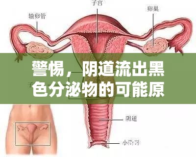 警惕，陰道流出黑色分泌物的可能原因、癥狀與應對策略