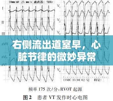 右側流出道室早，心臟節(jié)律的微妙異常與健康警示