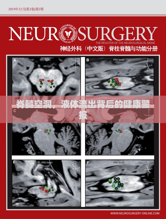 脊髓空洞，液體流出背后的健康警報