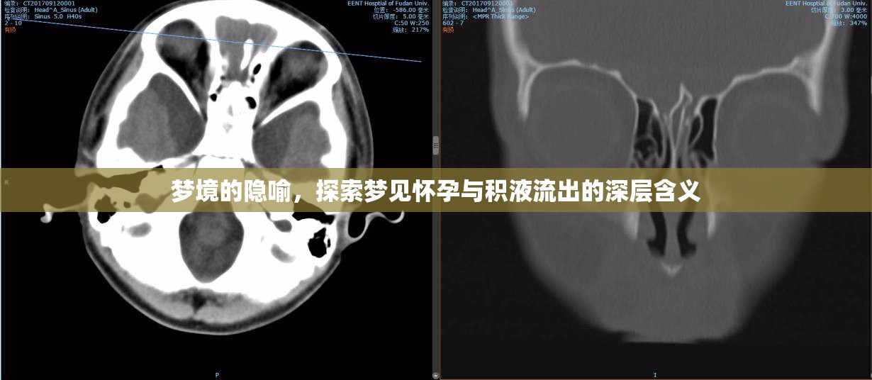 夢(mèng)境的隱喻，探索夢(mèng)見懷孕與積液流出的深層含義