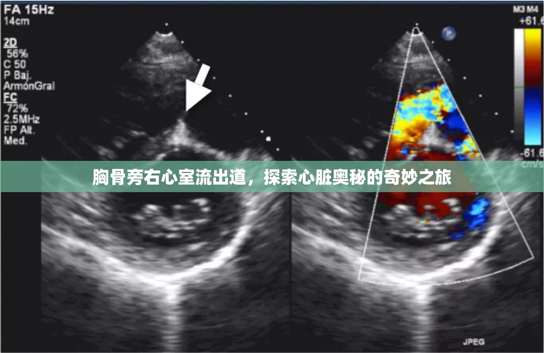 胸骨旁右心室流出道，探索心臟奧秘的奇妙之旅