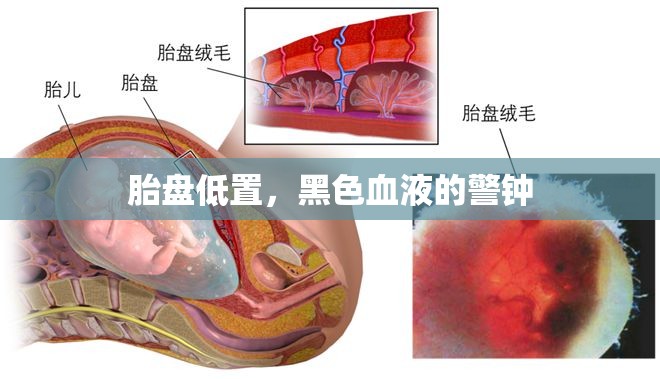 胎盤低置，黑色血液的警鐘