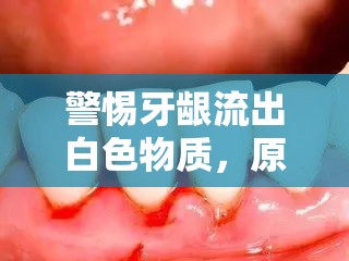 警惕牙齦流出白色物質(zhì)，原因、癥狀與預(yù)防措施