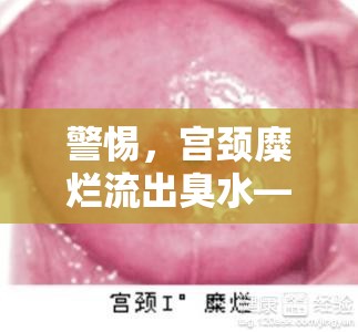 警惕，宮頸糜爛流出臭水——女性健康的隱形殺手