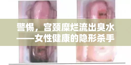 警惕，宮頸糜爛流出臭水——女性健康的隱形殺手