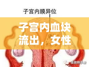 子宮內(nèi)血塊流出，女性健康的緊急警報(bào)