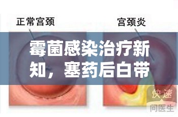 霉菌感染治療新知，塞藥后白帶流出的原因解析