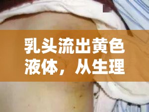 乳頭流出黃色液體，從生理現(xiàn)象到健康警示的全面解析