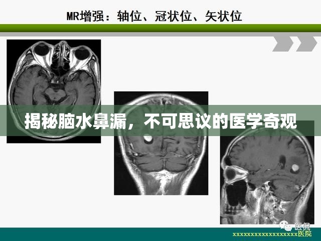 揭秘腦水鼻漏，不可思議的醫(yī)學(xué)奇觀