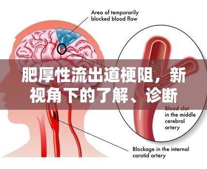 肥厚性流出道梗阻，新視角下的了解、診斷與治療策略