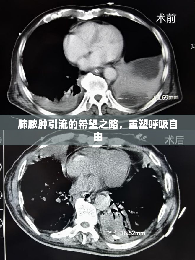 肺膿腫引流的希望之路，重塑呼吸自由