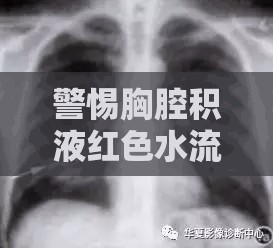 警惕胸腔積液紅色水流出，癥狀、原因與應(yīng)對策略