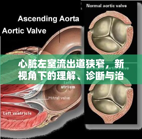 心臟左室流出道狹窄，新視角下的理解、診斷與治療