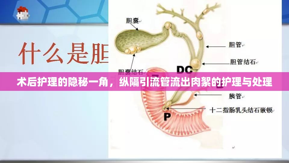 術(shù)后護理的隱秘一角，縱隔引流管流出肉絮的護理與處理