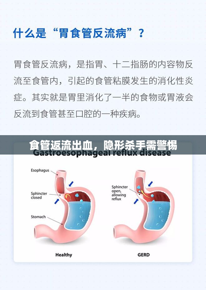 食管返流出血，隱形殺手需警惕