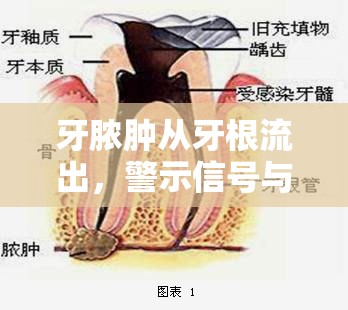 牙膿腫從牙根流出，警示信號(hào)與應(yīng)對(duì)策略