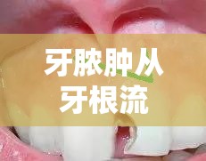 牙膿腫從牙根流出，警示信號(hào)與應(yīng)對(duì)策略