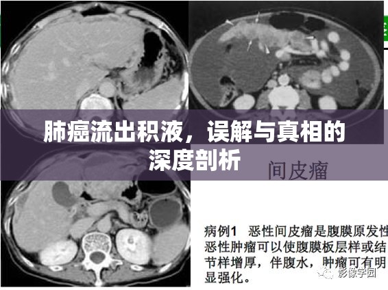 肺癌流出積液，誤解與真相的深度剖析