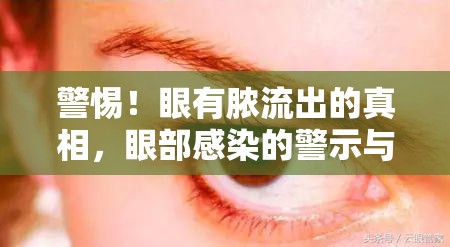 警惕！眼有膿流出的真相，眼部感染的警示與應(yīng)對(duì)策略