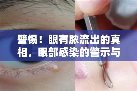 警惕！眼有膿流出的真相，眼部感染的警示與應(yīng)對(duì)策略