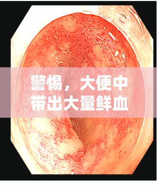 警惕，大便中帶出大量鮮血與粘液——腸道健康的嚴重警報