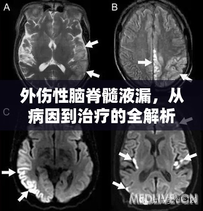 外傷性腦脊髓液漏，從病因到治療的全解析