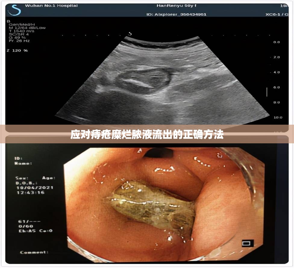 應(yīng)對(duì)痔瘡糜爛膿液流出的正確方法