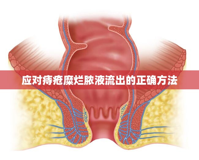 應(yīng)對痔瘡糜爛膿液流出的正確方法