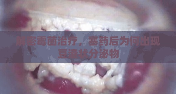 解密霉菌治療，塞藥后為何出現(xiàn)豆渣狀分泌物