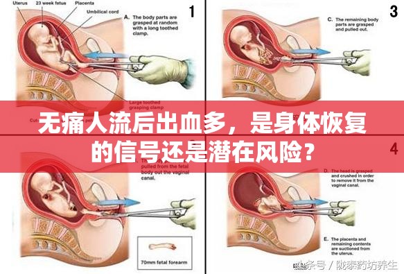 無痛人流后出血多，是身體恢復的信號還是潛在風險？