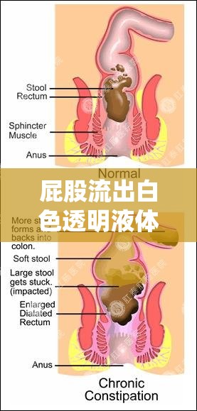 屁股流出白色透明液體的真相，健康、醫(yī)學(xué)與誤解的交織