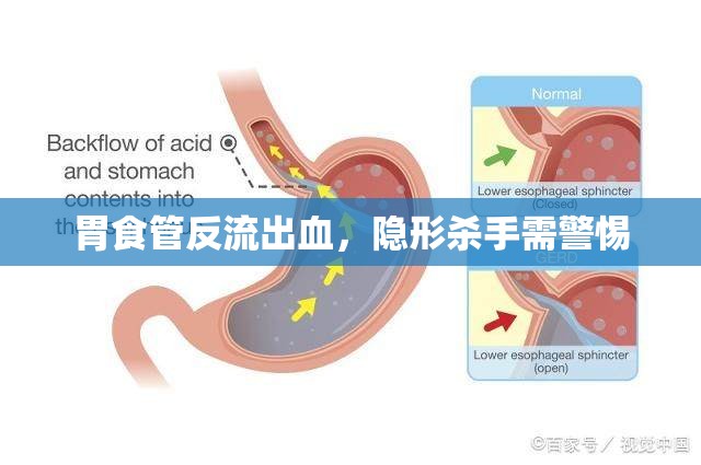 胃食管反流出血，隱形殺手需警惕