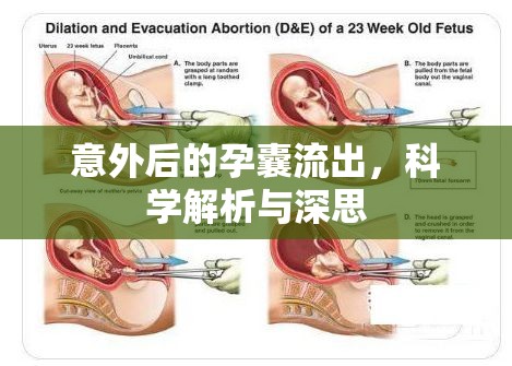 意外后的孕囊流出，科學(xué)解析與深思